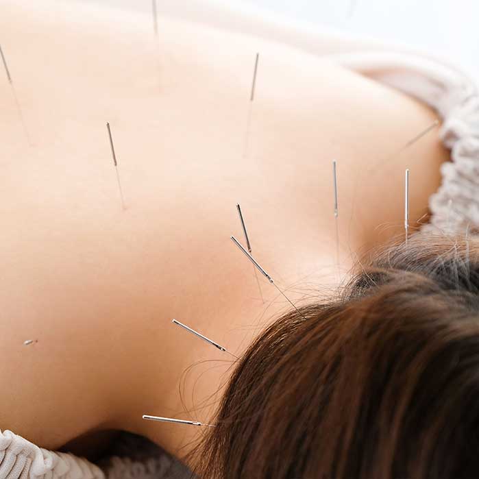 acupuncture for auto accident chiropractic treatment in Broomfield